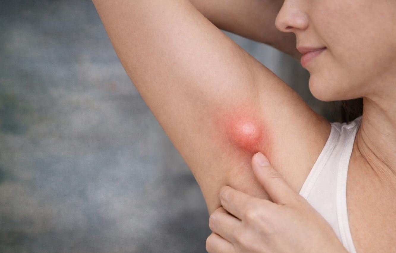 Koltuk Altındaki Şişlik Her Zaman Masum Değil: Ektopik Meme Dokusu Uyarısı